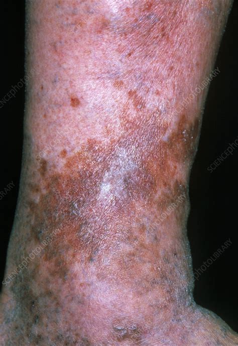 Varicose Eczema Stock Image M1500203 Science Photo Library