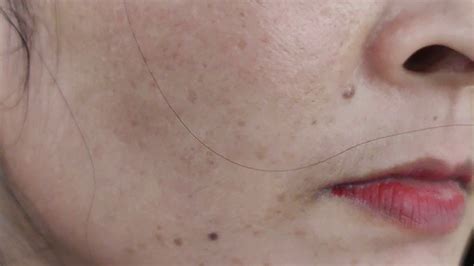 झांई Melasma Dark Cheek Spots Cured Completely Clinic Video Youtube