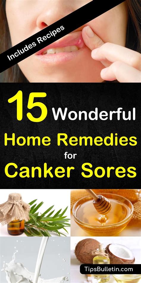 15 Canker Sore Relief Remedies That Work Canker Sore Remedy Canker