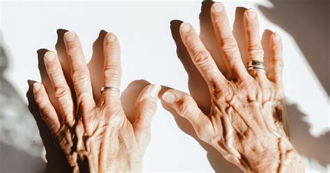 Psoriatic Arthritis Enthesitis Symptoms Causes Treatment And More