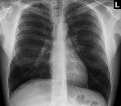The ribs show up as bright white, the lungs are large black areas on the left and right of the image, the heart is a gray area that appears in the black space represented by the right lung, and the diaphragm is a gray area at the bottom of the image. healthy lungs x ray Gallery