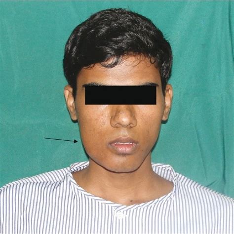 Pre Operative Photograph Showing Diffuse Extraoral Swelling Download