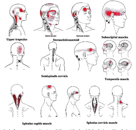 Pdf Referred Pain Areas Of Active Myofascial Trigger Points In Head