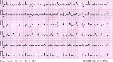 Right Bundle Branch Block Rbbb Ecg Learntheheart