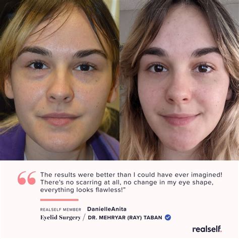 4 Reasons Younger Patients Are Getting Eyelid Surgery Realself News