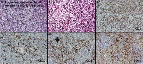 Cd10 Expression In Peripheral T Cell Lymphomas Complicated By A