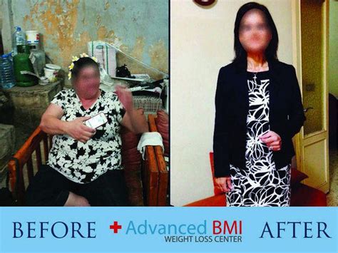 Surgery To Lose Weight In Lebanon Dr Nagi Jean Safa Beirut