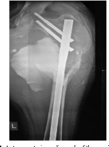 Figure 1 From A Proximal Femur Aneurysmal Bone Cyst Resulting In Amputation A Rare Case Report