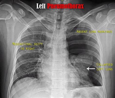 Pneumothorax Laptrinhx News