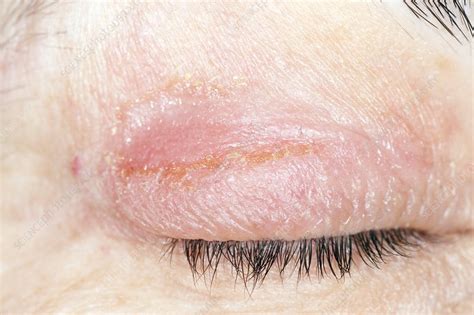 Infected Eczema On The Eyelid Stock Image C0117360 Science Photo