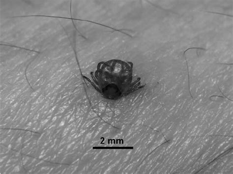Clinical Photograph Of The Nymphal Amblyomma Testudinarium Tick Found