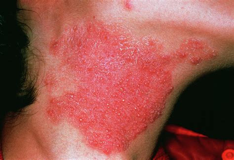 Fungal Skin Infection Photograph By Cnriscience Photo Library