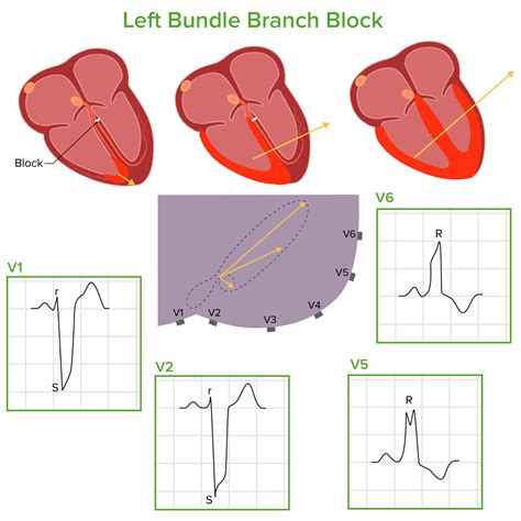 Mechanik Induzieren Hintergrund Right Bundle Block Kommerziell Knappe