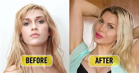 Swedish Model Who Had Ribs Removed Now Gets Implants To Pursue