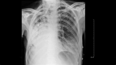 What is community acquired pneumonia defined by? Hospital-Acquired Pneumonia Clinical & Radiological ...
