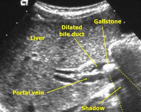 Common Bile Duct On Ruq Ultrasound Dailyem