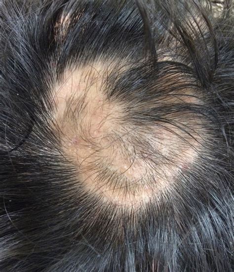 Hair graying pattern depends on gender, onset age and smoking habits. Quando a Alopecia atinge a autoestima?! | Ellen Maximo