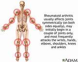 Photos of Holistic Treatment For Rheumatoid Arthritis Symptoms