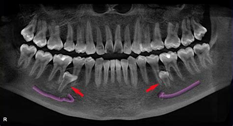 Saber si se escribe incluidos o incluídos es una duda que podemos tener. Escáner 3D para localización dientes incluidos: - Dentista ...