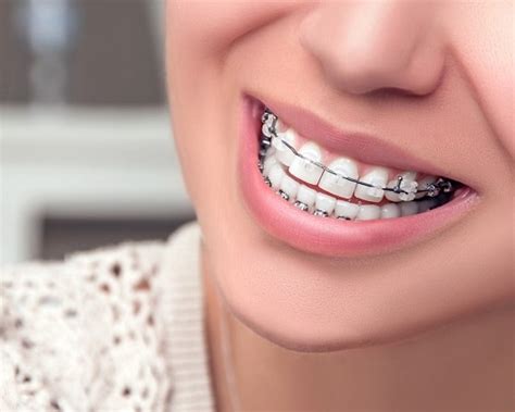 Includes home improvement projects, home repair, kitchen remodeling, plumbing, electrical, painting, real estate, and decorating. What to know about brace removal and after braces dental ...