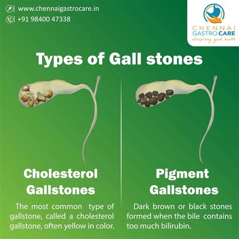 Gallstone Types Chennai Gastro Care Gallstones Gallstones Symptoms