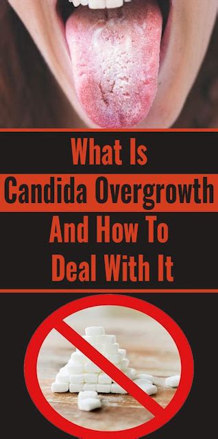 What Is Candida Overgrowth And How To Deal With It Wellness Guru