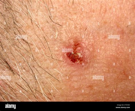 Malignant Tumor Of The Skin Stock Photo Alamy