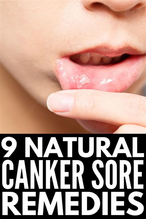 Natural And Effective 9 Canker Sore Remedies That Work Fast In 2020