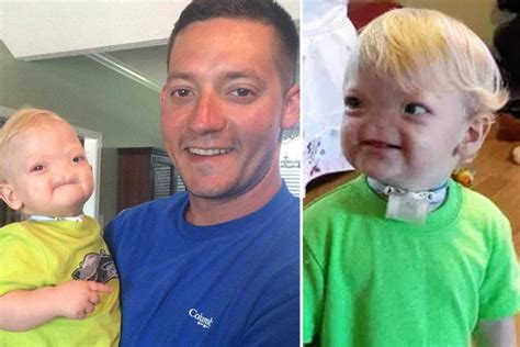 Baby Eli Thompson Who Was Born With No Nose Due To Ultra Rare Condition