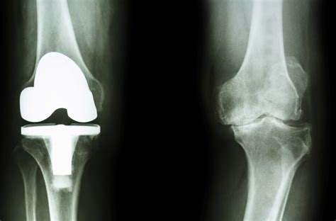 Total Knee Arthroplasty Dr Michael Serhal