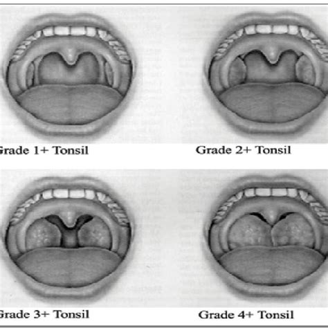Grading Of Palatine Tonsils Hypertrophy Proposed By L Brodsky 10