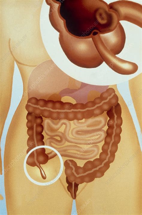 If your appendices use information from an outside source, cite it parenthetically within the text of the appendix and include the reference in the main reference list for the paper (do not. Artwork showing position and anatomy of appendix - Stock Image - P560/0066 - Science Photo Library