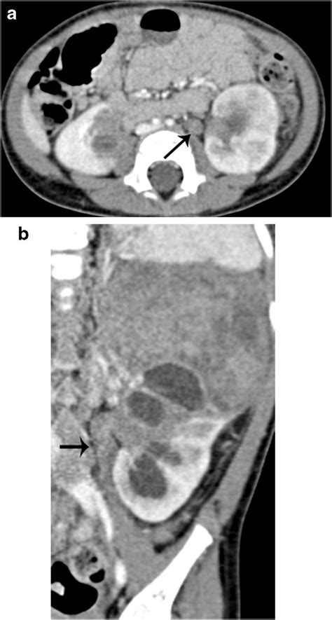 Stage Ii Wilms Tumor With Ureteral Extension In A 13 Month Old Girl