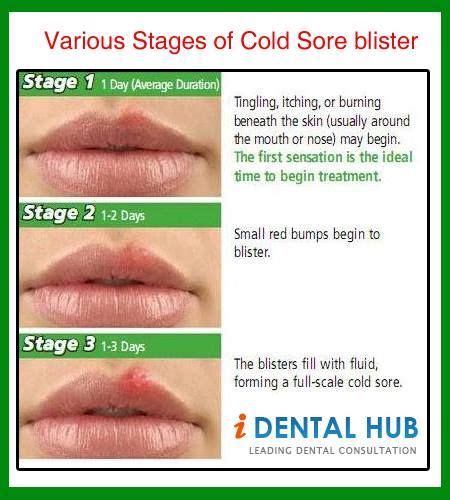 Various Stages Cold Sore Blister Cold Sore Treatment Cold Sore