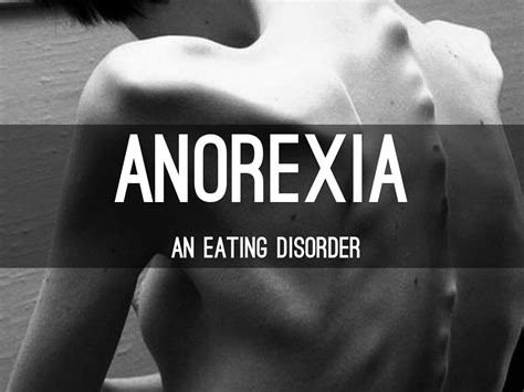 Anorexia By Sidney Woslager