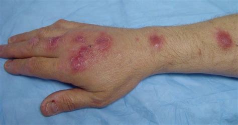 Is Massage Contraindicated For Sporotrichosis