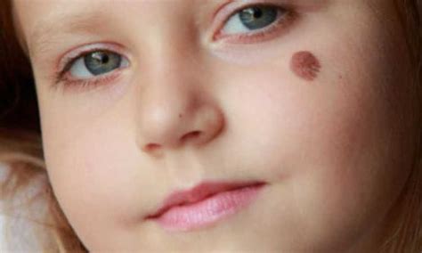 الرئيسية/صحة الأطفال والرضع/التبول المؤلم أو حرقان البول عند الأطفال. أنواع الوحمات عند الأطفال.. تعرفى عليها | أهل مصر