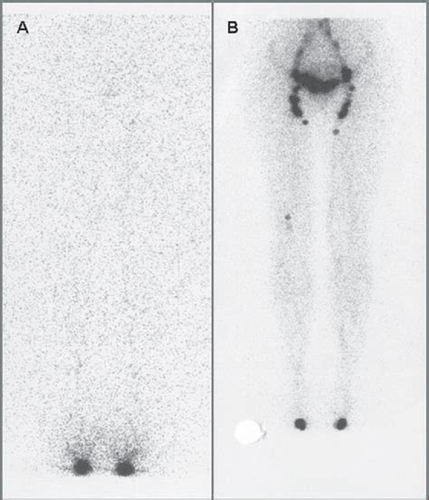 Dynamic Lymphoscintigraphy Of The Lower Extremities Front Back