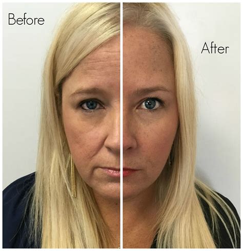 Want To Really Get Rid Of Wrinkles In 10 Days Gain That Youthful Glow