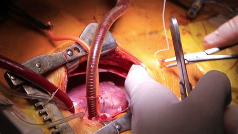 There are several doubts about minimally invasive & open heart surgery: Open Heart Surgery Closeup with Stock Footage Video (100% Royalty-free) 22166596 | Shutterstock