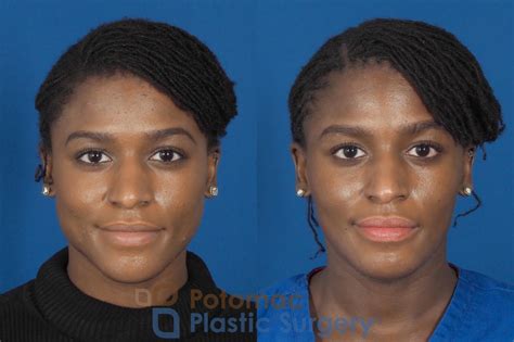 Facial Sculpting To Slim Face With Botox For Young Woman