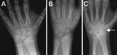 Wrist Radiographs With Normal Bone Age Joint Cartilage And