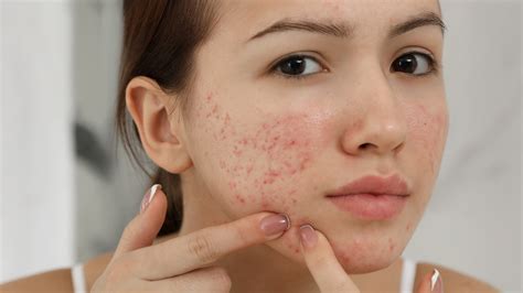 The Real Difference Between Hormonal And Cystic Acne