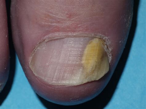 Fungal Infection Fingernail My Health Maven