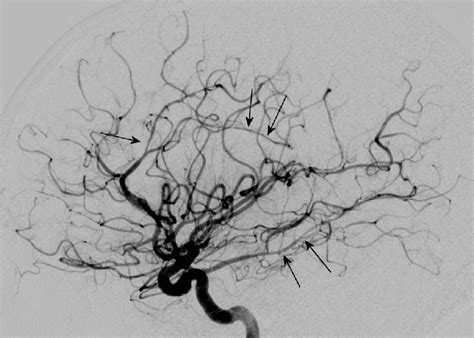 Digital Subtraction Angiogram Left Internal Carotid Artery Lateral