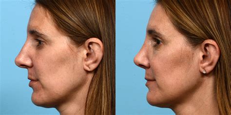 Rhinoplasty Before And After Patient 51 Dr Jeffrey Wise