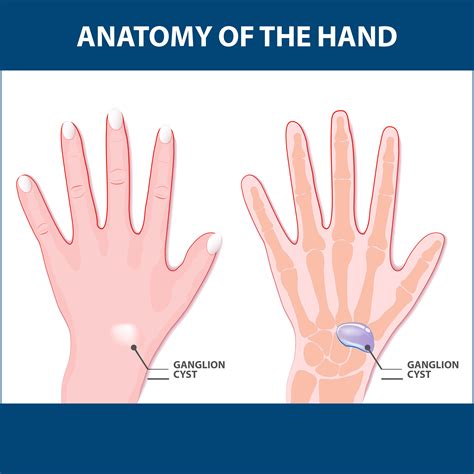 Ganglion Cyst Wrist Pictures Volar Retinacular Cysts They Grow Out Of The Tissues Surrounding