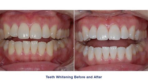 How Much Does Teeth Whitening Cost Design Your Smile