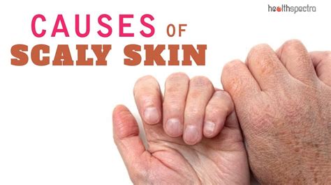 7 Major Causes Of Scaly Skin Youtube