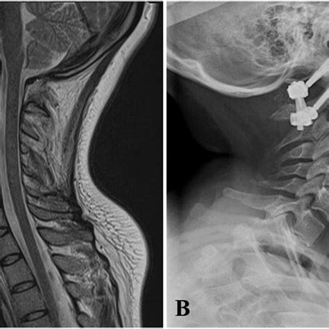 A T2 Sagittal Mr Imaging Of The Cervical Spine Shows Normal Spinal Cord